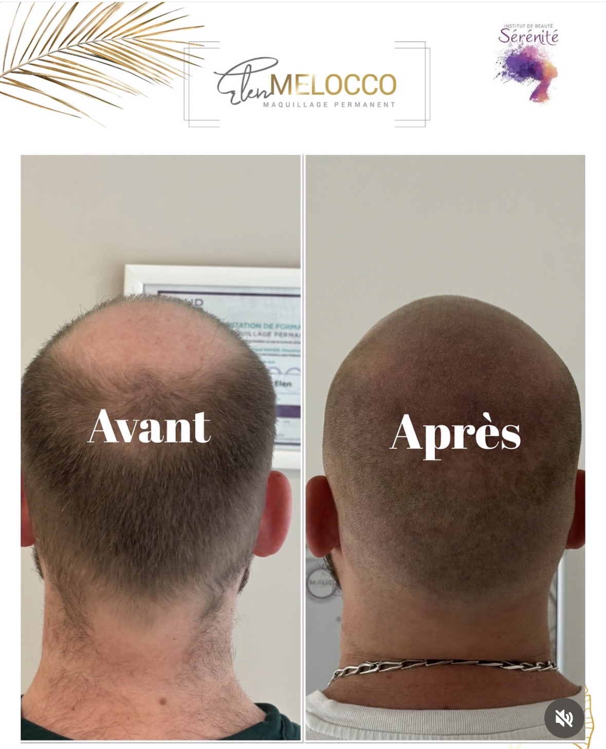 cheveux en normandie solution perte de cheveux alopecie calvitie perte de cheveux en normandie pres de caen et de bayeux a douvres la delivrande perte de cheveux une solution la pigmentation capillaire