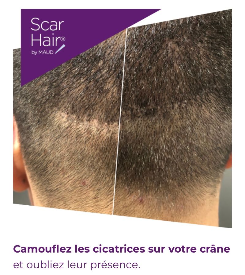scar hair cicatrice perte de cheveux