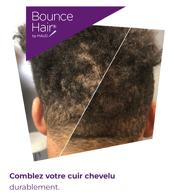 perte de  cheveux