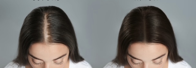 perte de cheveux