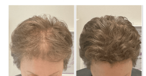 Cheveux clairsemés, zones dégarnies ? Retrouvez confiance avec la tricopigmentation capillaire !