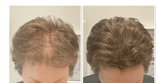 Cheveux clairsemés, zones dégarnies ? Retrouvez confiance avec la tricopigmentation capillaire !