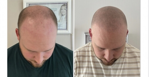 Témoignage d'Hugo 27 ans  : pigmentation capillaire