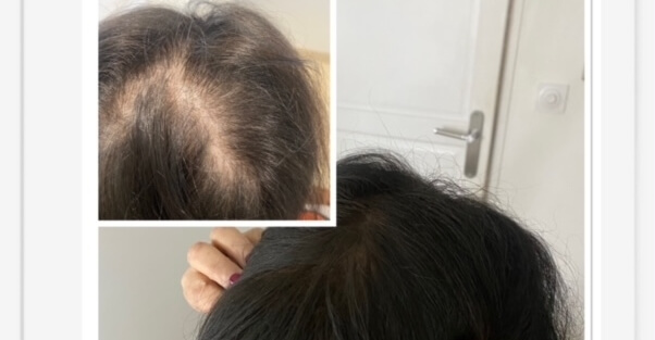 Perte de Cheveux : tricopigmenation du cuir chevelu