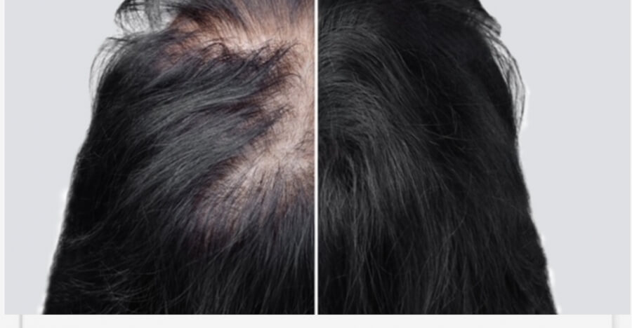 Tricopigmentation Capillaire pour Quels clients  ?